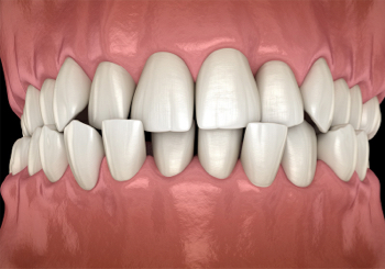 Common Problem - Crossbite